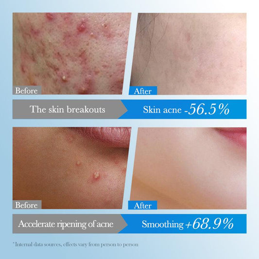 Pimple Patches - 78 pack